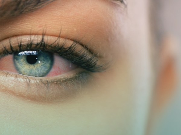 3 Things You NEED To Know About Dry&nbsp;Eyes